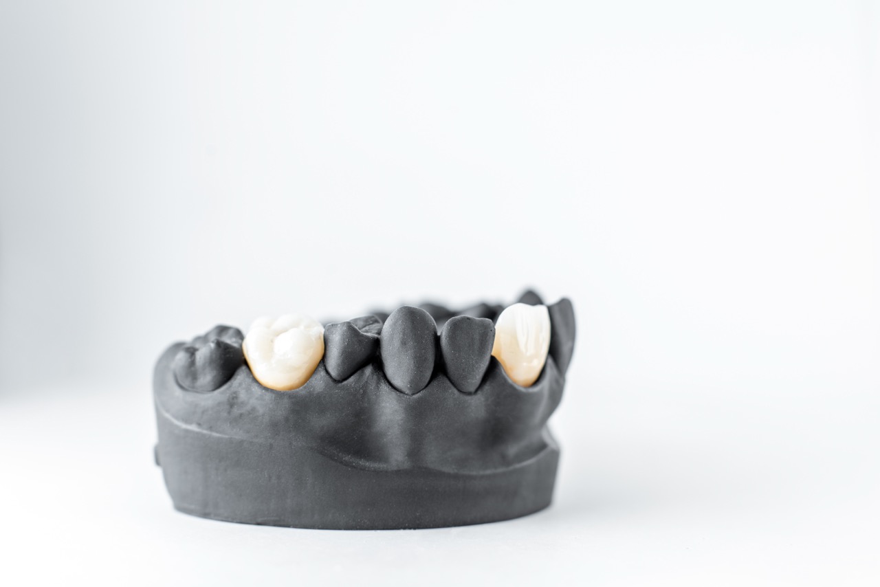 Dental Implants illustration 1